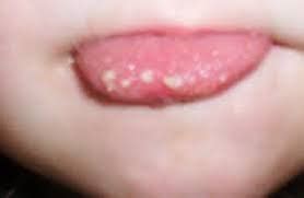 white tag on tongue|tiny white bumps on tongue.